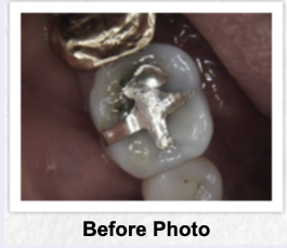 Black decay around an old silver filling - This case was an old silver/mercury filling with decay (the black halo). Easily replaced with a tooth colored composite filling - Looks Great! Black decay around an old silver filling - This case was an old silver/mercury filling with decay (the black halo). Easily replaced with a tooth colored composite filling - Looks Great!
