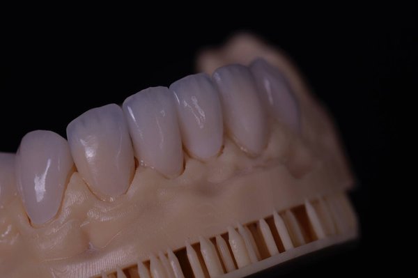 Best Veneers in South Florida - 10 custom veneers designed and placed over two visits. Minimal-prep technique fixed chips, discoloration, and minor crowding, giving the patient a bright, natural-looking smile that’s durable and stain-resistant. Call us to book a consultation if you're interested! Best Veneers in South Florida - 10 custom veneers designed and placed over two visits. Minimal-prep technique fixed chips, discoloration, and minor crowding, giving the patient a bright, natural-looking smile that’s durable and stain-resistant. Call us to book a consultation if you're interested!