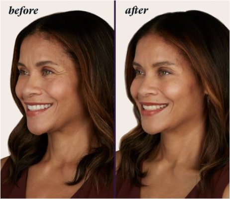 Botox - BOTOX® Cosmetic (onabotulinumtoxinA) is the only FDA-approved treatment to temporarily improve both moderate to severe frown lines between the brows and crow’s feet in adults. You can get treated in both areas at the same time—that’s the beauty of BOTOX® Cosmetic. Botox - BOTOX® Cosmetic (onabotulinumtoxinA) is the only FDA-approved treatment to temporarily improve both moderate to severe frown lines between the brows and crow’s feet in adults. You can get treated in both areas at the same time—that’s the beauty of BOTOX® Cosmetic.