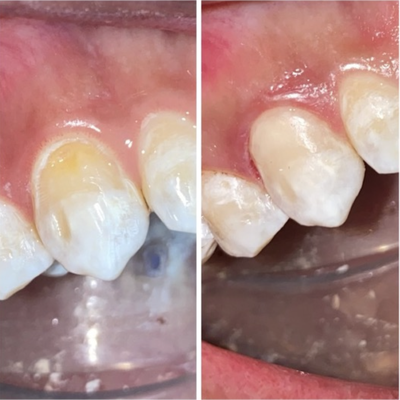 Composite Bonding - Composite Bonding at Fuller Smiles
