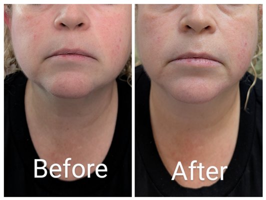 SIGNATURE FACE, HEAD AND NECK BEAUTY MASSAGE - These pictures are showing results with treatment packages containing MLD, sculpting and lifting beauty massage of face and neck and bleph areas with or without added microcurrent treatment and high frequency, depending on the state of the tissues. Medical conditions are always considered before any sessions to ensure your safety first. SIGNATURE FACE, HEAD AND NECK BEAUTY MASSAGE - These pictures are showing results with treatment packages containing MLD, sculpting and lifting beauty massage of face and neck and bleph areas with or without added microcurrent treatment and high frequency, depending on the state of the tissues. Medical conditions are always considered before any sessions to ensure your safety first.