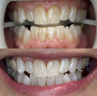 Zoom Whitening - Various Before and Afters of our in office Zoom teeth whitening treatment. Call now to make an appointment! Zoom Whitening - Various Before and Afters of our in office Zoom teeth whitening treatment. Call now to make an appointment!