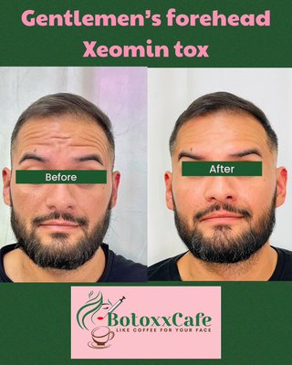 Botox - How Botox Works?

Botox®, is the popular wrinkle softening treatment approved for cosmetic use in 2006.  Our specialist aesthetics specialist, Shirley RN will select anti-wrinkle treatments, such as Botox®, to help you stave off the ageing process.  Safe and straightforward, treatments can be used alongside other treatments such as dermal fillers to achieve an extremely youthful results.

Botox® is injected into to the dynamic facial muscles responsible for the creation of wrinkles; it relaxes these facial muscles and keep them from contracting to restore a more youthful appearance.   

• V-neck lines
• Frown forehead lines and around the eyes
• Crow’s feet
• Hyperhidrosis (decreases sweating)
• Migraines
• Jaw line giving a Nefertiti look
• Lip flips (enhancing upper lip definition)

It works by relaxing the muscle that its injected into, this limits the repetitive muscle movements that can cause lines and wrinkles. This can help prevent the formulation of new lines, and soften and improve existing lines and reduce wrinkles.

Subtle reshaping and lift can be applied to the shape of your brow, face and eyes creating a younger, fresher looking you.

A Botox® anti wrinkle treatment uses tiny needles, which you can barely even feel. It is not painful and rarely causes any visible effect, so no one will even know you have had it. The treatment will last for around four to six months and can then be followed with a top up to maintain your looks.

It is entirely reversible, so if left to completely wear off, your natural lines will reappear.

Botox® can also be used to reduce excessive perspiration (hyperhidrosis) and treatments are extremely effective, quickly reducing this sometimes embarrassing condition