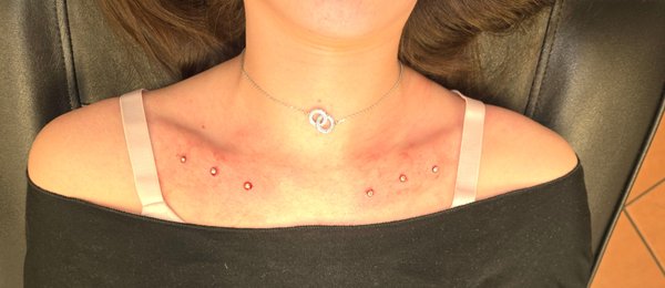 Dermal piercings by Bobby - These are pics of recent dermal (single point piercings) I had the pleasure of doing for a few clients over the last month. Dermal piercings by Bobby - These are pics of recent dermal (single point piercings) I had the pleasure of doing for a few clients over the last month.