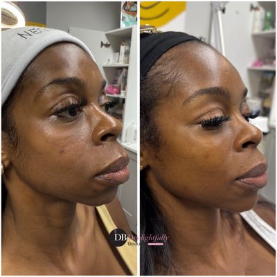 Facial Balancing - As we age, we lose volume in our faces, which gives us a loose or saggy appearance. Deelightfully Beautiful Aesthetics offers different products to help correct the effects of aging. These products can enhance lips, diminish fine lines and wrinkles, reshape your nose, contour your chin, define your jawline, and add volume to your cheeks. Your provider will listen to your concerns and determine the appropriate products to achieve your desired look. Facial Balancing - As we age, we lose volume in our faces, which gives us a loose or saggy appearance. Deelightfully Beautiful Aesthetics offers different products to help correct the effects of aging. These products can enhance lips, diminish fine lines and wrinkles, reshape your nose, contour your chin, define your jawline, and add volume to your cheeks. Your provider will listen to your concerns and determine the appropriate products to achieve your desired look.
