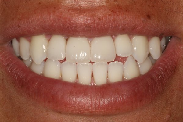 Teeth Whitening and Bonding - Teeth whitening can be a great option to improve the appearance of the tooth without doing any dental work.  It is always best to whiten your teeth first and then match porcelain veneers to that color.  This gives a very natural result and Dr. Edwards' patient was thrilled!