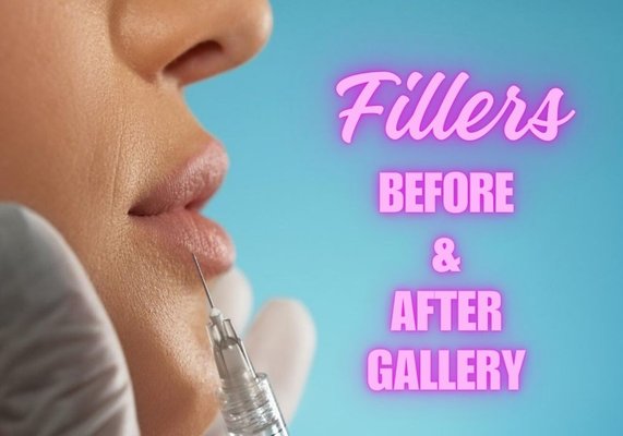 Fillers Before & After Gallery - Meet the amazing team from Unique Spa Services & Hair Today Gone Tomorrow Electrolysis! Fillers Before & After Gallery - Meet the amazing team from Unique Spa Services & Hair Today Gone Tomorrow Electrolysis!