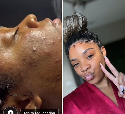 SKYN BY NIC - This service is great for clients who suffer from severe acne breakouts and scarring SKYN BY NIC - This service is great for clients who suffer from severe acne breakouts and scarring