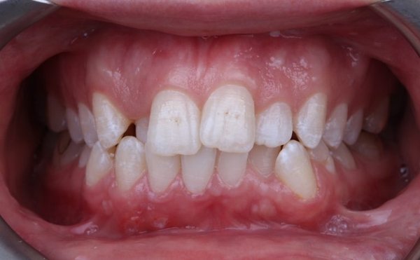 Invisalign Clear Aligners Treatment! - We love caring for our patients! We offer the best, most advanced Invisalign treatments to help perfect your smile! Don't take our word for it, see what our happy Invisalign patient had to say after their treatment!

"As a person who was always scared of going to the dentist, I can finally say I found the perfect place. Not only does Smart Smile Dental have your best interests in mind, but they also have the best ways at making you feel comfortable. I completely recommend this place for anyone looking to do Invisalign treatment, they have a great team that’s always ready to help" - Debby O, Invisalign Patient

If you're looking to straighten your teeth to improve the look and feel of your smile, call our office today!