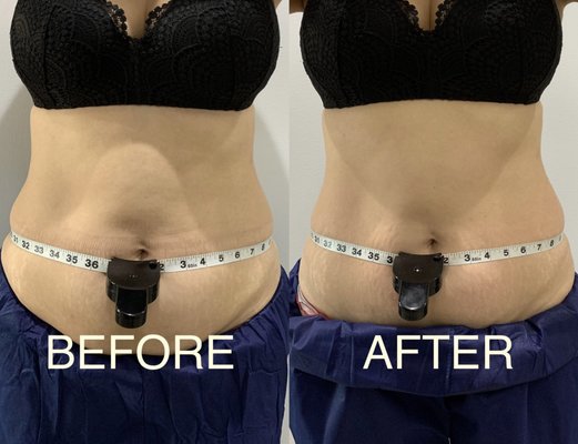 Lipo Cavitation and RF Body Contouring - If you’re looking for a revolutionary fat and cellulite removal solution without needles, anesthesia, or surgery - look no further than Lipo Cavitation & RF Body Contouring. This advanced system literally uses ultrasound to breakdown your fat cells and then helps your body naturally flush them away. For belly fat? No problem. Thighs? Check! Chin and arms? Absolutely! And unlike traditional liposuction, there’s no recovery time – just some healthy tips we can give you to help get the best out of the treatment. It’s pain free and fast, so you can start seeing the results after just one 30-50 minute session – even if you’ve already given up on dropping those pesky lost inches! So what’re you waiting for? Step up your beauty game with Lipo Cavitation & RF – it's like magic without the wands! Lipo Cavitation and RF Body Contouring - If you’re looking for a revolutionary fat and cellulite removal solution without needles, anesthesia, or surgery - look no further than Lipo Cavitation & RF Body Contouring. This advanced system literally uses ultrasound to breakdown your fat cells and then helps your body naturally flush them away. For belly fat? No problem. Thighs? Check! Chin and arms? Absolutely! And unlike traditional liposuction, there’s no recovery time – just some healthy tips we can give you to help get the best out of the treatment. It’s pain free and fast, so you can start seeing the results after just one 30-50 minute session – even if you’ve already given up on dropping those pesky lost inches! So what’re you waiting for? Step up your beauty game with Lipo Cavitation & RF – it's like magic without the wands!