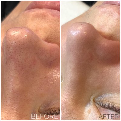 HydraFacial - The ONLY procedure that combines cleansing, exfoliation, extraction, hydration and antioxidant protection simultaneously, resulting in clearer, more beautiful skin with no discomfort or downtime.
The treatment is soothing, moisturizing, non-invasive and non-irritating. HydraFacial - The ONLY procedure that combines cleansing, exfoliation, extraction, hydration and antioxidant protection simultaneously, resulting in clearer, more beautiful skin with no discomfort or downtime.
The treatment is soothing, moisturizing, non-invasive and non-irritating.