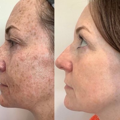 Brown Spots - Sun Exposure (UV Radiation): This is the most common cause. Ultraviolet (UV) light stimulates melanocytes (pigment-producing cells) to produce extra melanin as protection. Over time, this leads to:
Solar Lentigines (often called Age Spots or Sun Spots): Flat, brown spots that typically appear on sun-exposed areas like the face, hands, and arms.
Aging: While often sun-related, age can also cause melanocytes to become more concentrated in certain areas. Brown Spots - Sun Exposure (UV Radiation): This is the most common cause. Ultraviolet (UV) light stimulates melanocytes (pigment-producing cells) to produce extra melanin as protection. Over time, this leads to:
Solar Lentigines (often called Age Spots or Sun Spots): Flat, brown spots that typically appear on sun-exposed areas like the face, hands, and arms.
Aging: While often sun-related, age can also cause melanocytes to become more concentrated in certain areas.