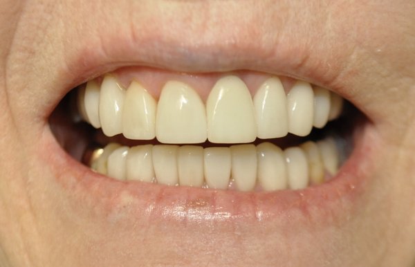Cosmetic Bridge - A bridge is a wonderful cost effective option  for quickly and minimally invasively restoring form function and esthetics to our patients. This procedure was done in less than a week with only 2 hours in the office.
