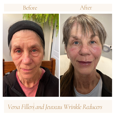 Versa Dermal Fillers - Versa dermal fillers are used to create volume where is has been depleted with age or weight loss OR add to areas the client would like to volumize for a more balanced and beautiful look. Versa Dermal Fillers - Versa dermal fillers are used to create volume where is has been depleted with age or weight loss OR add to areas the client would like to volumize for a more balanced and beautiful look.