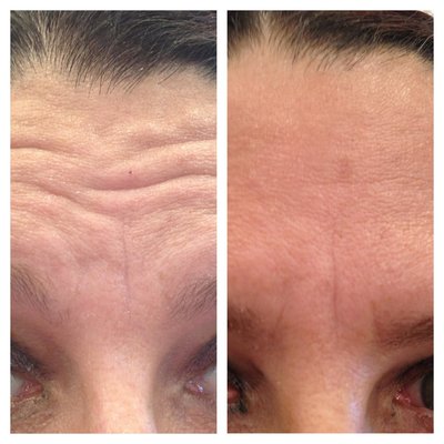 Botox - Botox is a neurotoxin that can relax the muscles on areas of the face and neck which cause wrinkles associated with facial expressions or facial pain. Treatment with botulinum toxin can cause your facial expression lines or wrinkles to be less noticeable or essentially disappear.