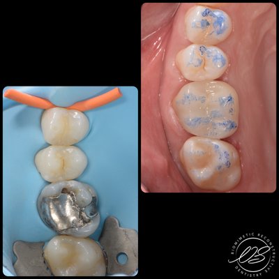 Biomimetic Excellence in Cracked Molar Repairs - Preserving Dental Integrity: Biomimetic Excellence in Cracked Molar Repairs

In this compelling case, Dr. Nima Shayesteh, a CERTIFIED Biomimetic Dentist, navigates the intricate challenges posed by a molar housing a substantial silver filling. The tooth's integrity is compromised not merely by visible cracks but, more critically, by deep dentinal cracks concealed beneath the surface. These cracks, often lurking beneath large silver fillings, carry the potential for nerve damage and eventual tooth splitting.

Biomimetic Dentistry, under Dr. Shayesteh's expertise, introduces a crucial dimension – the ability to identify and meticulously address these deep dental cracks. Utilizing high magnification, such as a Dental microscope, a specialized crack dissection protocol is executed. This protocol prevents the progression of cracks, averting nerve damage and mitigating the risk of tooth loss—a fundamental attribute of Biomimetic dentistry.

As tensile forces from the large silver filling contributed to the cracks, Biomimetic dentistry preparation designs come into play. These designs strategically convert harmful tensile forces into compressive forces, promoting tooth integrity. The biodome overlay design, a hallmark of Biomimetic restorations, further fortifies the tooth by maintaining a bonded structure.

Dr. Shayesteh's commitment to excellence extends to the meticulous steps taken in adhesive reconstructive cases. Unlike traditional dentistry, where these steps may not be standard, Dr. Shayesteh incorporates at least 14 additional steps. In this case, immediate dentinal sealing was implemented to prevent sensitivity and bacterial ingress, simultaneously bolstering bond strength by up to 400%. Furthermore, the tooth's floor was reinforced with a weaved polyethylene fiber reinforcement Ribbond fibers, exemplifying the depth of care in the Biomimetic protocol.

Join Dr. Nima Shayesteh at Concierge Smile Boutique for a personalized consultation, and experience Dentistry Par Excellence designed to preserve your dental health with the utmost precision and care.