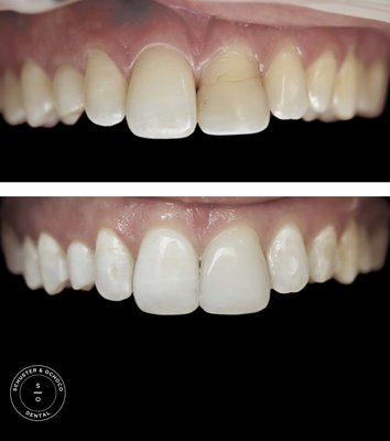 Composite Fillings and bondings - Composite fillings can be used to conservatively fix cavities as well as fixing small fractures on front teeth. Composites can also be used to create indirect composite veneers to brighten a smile or reshape front teeth with the right circumstances. We only use the best materials and spare no expense when choosing the materials for our composite fillings. We use materials from 3M and VOCO.