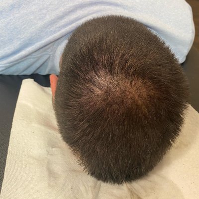 Male Scalp Pigmentation - Safest and easiest way to combat hair thinning. This procedure is done with a tattoo machine. Tiny dots are applied to the scalp to resemble hair follicles. This procedure will also stimulate new hair growth aka reversing the hands of time. Male Scalp Pigmentation - Safest and easiest way to combat hair thinning. This procedure is done with a tattoo machine. Tiny dots are applied to the scalp to resemble hair follicles. This procedure will also stimulate new hair growth aka reversing the hands of time.