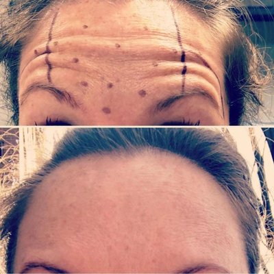 Botox - We have been injecting Botox and Dysport for nearly 20 years!  Our experience shows on your face.  Why risk it?  Let us pamper you while respected medical professions perform your treatment.
.
.
Treatment by Beth Curry, PA
. 
#botox #xeomin #dysport #neuromodulators #wrinkles #brotox #cosmeticlasers #co2laser #microneedling #fillers #dermalfillers #juvederm #restalyne #california #caliPA #aestheticPA #erPA #aestheticmedicine #aestheticinjector