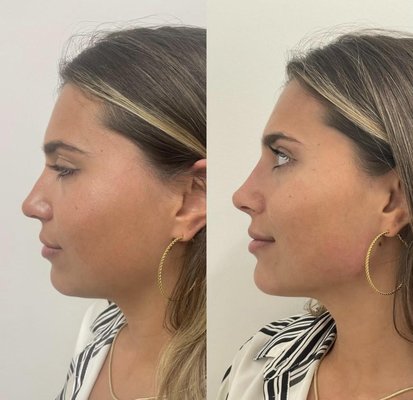 Facial Balancing - Facial balancing is an advanced and highly individualized aesthetic approach designed to help people achieve facial balance and facial symmetry.