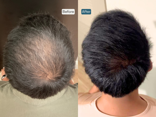 Hair Restoration - PRP (Platelet-Rich Plasma) Hair Restoration harnesses your body’s own growth factors to stimulate hair follicles, improve scalp health, and support natural regrowth. Hair Restoration - PRP (Platelet-Rich Plasma) Hair Restoration harnesses your body’s own growth factors to stimulate hair follicles, improve scalp health, and support natural regrowth.