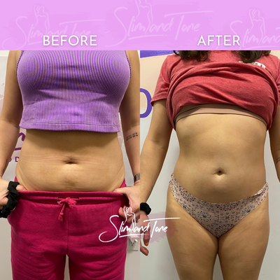 Before and Afters - Electromagnetic Treatment to Build muscle and burn fat simultaneously. If your looking for a more "TONED" appearance and to strengthen certain muscle groups and get the most out of your workouts. Before and Afters - Electromagnetic Treatment to Build muscle and burn fat simultaneously. If your looking for a more "TONED" appearance and to strengthen certain muscle groups and get the most out of your workouts.