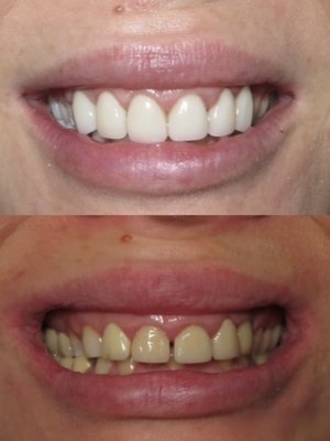 New smile makeover - Patient presented with multiple broken and chipped teeth and expressed a desire to improve the appearance of their smile and achieve a brighter, more attractive result. New smile makeover - Patient presented with multiple broken and chipped teeth and expressed a desire to improve the appearance of their smile and achieve a brighter, more attractive result.