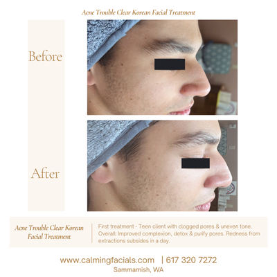 Acne Trouble Clear Korean Treatment - Before & After - Results after just 1 treatment of Acne Trouble Clear Korean Treatment for skin purification & complexion correction.
Teen client with clogged pores, acne and uneven complexion due to outdoor sports. With just one treatment, we saw complexion correction and clean pores (nose, forehead, side of face) Acne Trouble Clear Korean Treatment - Before & After - Results after just 1 treatment of Acne Trouble Clear Korean Treatment for skin purification & complexion correction.
Teen client with clogged pores, acne and uneven complexion due to outdoor sports. With just one treatment, we saw complexion correction and clean pores (nose, forehead, side of face)