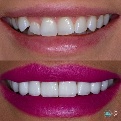 Veneers - We offer Hoffman Cosmetics, Dr. Nathan Hoffman’s exclusive brand for cosmetic dentistry. Hoffman Cosmetics ceramic veneers are completely customized to each smile using an extremely conservative prep technique. The material used to craft the veneers offers a high aesthetic potential with a translucent appearance, allowing light to pass through them, just as natural teeth do. The minimal prep technique in conjunction with the high-grade material, results in veneers that look alive and offer a perfectly natural appearance. Veneers - We offer Hoffman Cosmetics, Dr. Nathan Hoffman’s exclusive brand for cosmetic dentistry. Hoffman Cosmetics ceramic veneers are completely customized to each smile using an extremely conservative prep technique. The material used to craft the veneers offers a high aesthetic potential with a translucent appearance, allowing light to pass through them, just as natural teeth do. The minimal prep technique in conjunction with the high-grade material, results in veneers that look alive and offer a perfectly natural appearance.