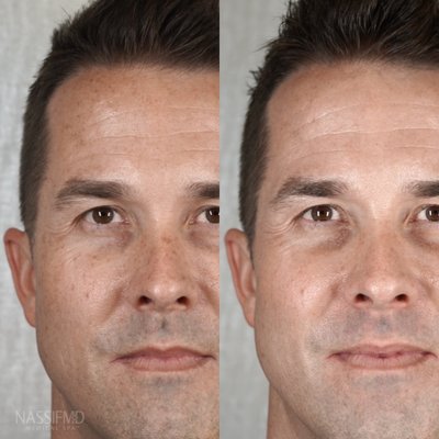 Laser Treatments - Before & After photos of Laser Treatments, Microneedling, Chemical Peels & More Laser Treatments - Before & After photos of Laser Treatments, Microneedling, Chemical Peels & More