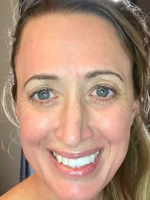 Fibroblast for Forhead and Marionette Lines - Fibroblast provides an alternative to skin tightening without necessitating dangerous surgical procedures. This process secretes collagen proteins that help maintain the structural framework of tissues.