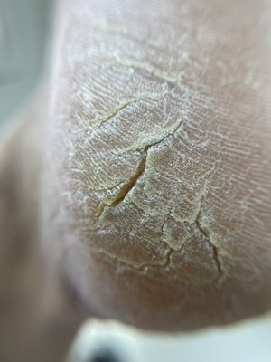 Smart pedicure. - This service is very rare, hard to find a specialist who can do the right certified technique. We can help! If you have cracked heels or calluses. Smart pedicure. - This service is very rare, hard to find a specialist who can do the right certified technique. We can help! If you have cracked heels or calluses.