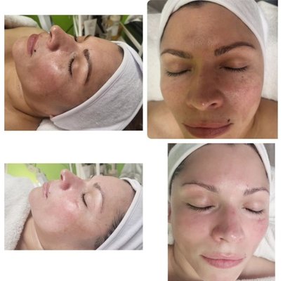 Various Facial Treatments - Picture's talks itself , see differences in before and after pictures
