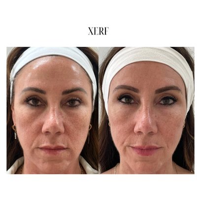 XERF Structural Skin Tightening - A Structural Skin Tightening treatment that can remodel the structure of tissue to restore firmness from within. It delivers all the skin-tightening, collagen-boosting power of radiofrequency (RF) energy, without numbing or needles. This treatment delivers RF energy deeper into the skin, reaching the shallow, middle, and deep layers, where real change begins.