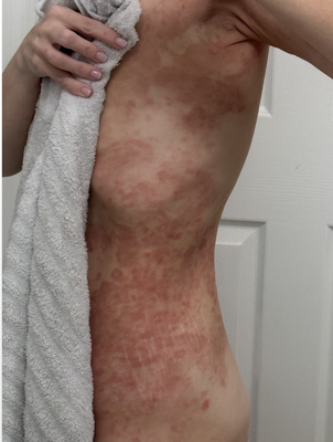 ✨ Transformative Results with Ozone Therapy ✨ - Meet Our Patient, a resilient fighter who faced the challenges of mold exposure and an autoimmune disorder. After various treatments, no answers, and unending Dr appointments...they discovered the healing power of Ozone Therapy—After just ONE session.....and the results have been nothing short of life-changing! 🌱

🌟 Improved Energy Levels
🌟 Reduced Inflammation
🌟 Immediate Symptom Reduction
🌟 Enhanced Overall Wellness

Ozone therapy works by promoting oxygenation, reducing oxidative stress, and supporting the body’s natural healing processes. For Clio, it’s been a game-changer in reclaiming their health and vitality. 🩵

👉 Are you ready to explore the benefits of ozone therapy for yourself or someone you love? Alive Ozone Therapy Spa can help! Let’s talk about how it could support your healing journey.