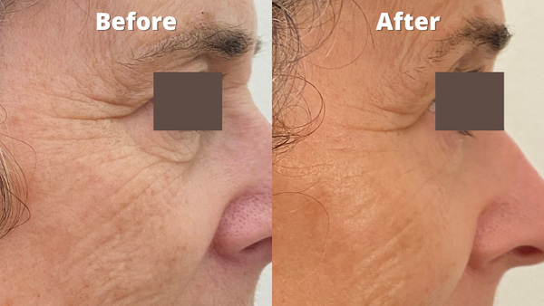 Facial Acupuncture - Unique combination of oriental acupuncture and modern medical technology Facial Acupuncture - Unique combination of oriental acupuncture and modern medical technology