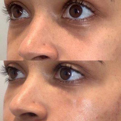 Tear Troughs - Tear Trough Treatment Tear Troughs - Tear Trough Treatment