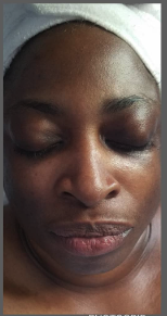 ITS THE GLOW FOR ME! - This beautiful client of mine came in with hyperpigmentation issues she's had for many years. Although the picture doesn't do justice she had immediate improvement in her skins texture & appearance with just one treatment of product based microdermabrasion!! So excited she will be following me outside of school & we can get her looking skintabolous!! ITS THE GLOW FOR ME! - This beautiful client of mine came in with hyperpigmentation issues she's had for many years. Although the picture doesn't do justice she had immediate improvement in her skins texture & appearance with just one treatment of product based microdermabrasion!! So excited she will be following me outside of school & we can get her looking skintabolous!!