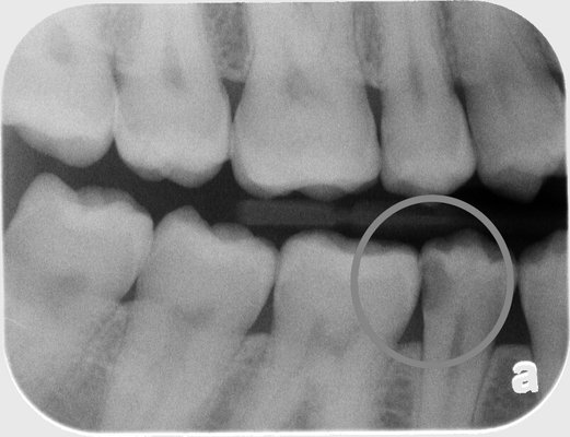 Cavity Fix - Teeth feeling sensitive? Don't wait too long or you'll end up needing a root canal or an extraction. This patient complained of tooth sensitivity to temperature and sweets. Cavity Fix - Teeth feeling sensitive? Don't wait too long or you'll end up needing a root canal or an extraction. This patient complained of tooth sensitivity to temperature and sweets.