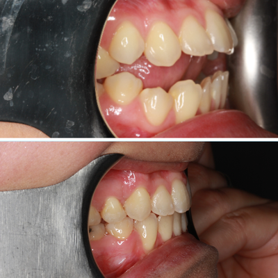 Orthodontics Before/After Transformations! - At Dentist of Montclair, we help transform smiles with metal braces, porcelain ceramic braces, and Invisalign® clear braces. Call us to schedule a consultation! (909) 413-4452 https://www.dentistsmontclair.com/
