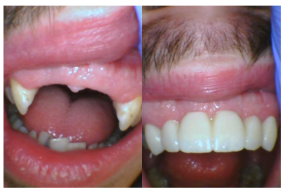 New Smile! - A new smile for our patient! He was extremely happy with the results and we were thrilled to see it all. A 6 unit bridge to fill in his smile. New Smile! - A new smile for our patient! He was extremely happy with the results and we were thrilled to see it all. A 6 unit bridge to fill in his smile.