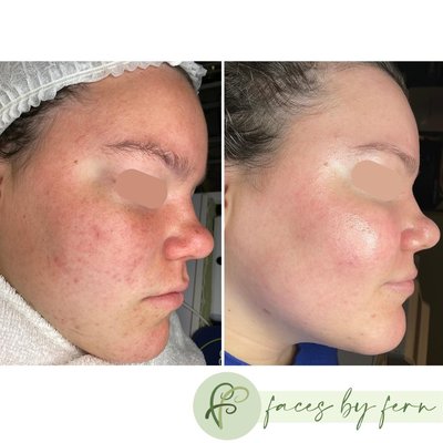 Boot Camp Client S.B. - Did you catch the smile on her face? Clearer skin just in time for the School Formal! Her skin healed so dramatically even within the first few weeks because the @facerealityskincare routine she started using did a superb job of healing her damaged skin barrier. The new glow is REAL! We love it.