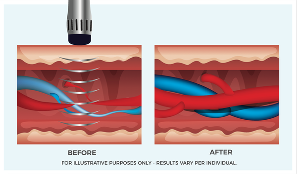 Gainswave for Men - Gainswave is the best treatment for ED. The Painless drug-free procedure with no downtime and no side effects. Gainswave opens blood vessels for stronger erections. Book your free consultation online or call for an appointment.  https://revitalwave.com/erectile-dysfunction/
631-597-0000