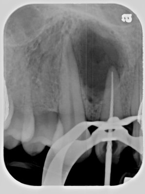 Dental Surgery with bone graph. - Don’t wait any longer. Call us today for an appointment. Dental Surgery with bone graph. - Don’t wait any longer. Call us today for an appointment.