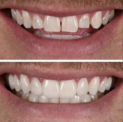 Bridge Work - Examples of Bridge Work at Zen Dentistry Bridge Work - Examples of Bridge Work at Zen Dentistry