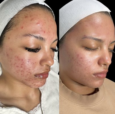 Scar Therapy - Improves the overall tone and texture of the skin, helps to improve fine lines, wrinkles , scarring, pigmentation, stretch marks and more.
This is the preferred service for acne scars . Multiple treatments are recommended 4-6 weeks apart. Scar Therapy - Improves the overall tone and texture of the skin, helps to improve fine lines, wrinkles , scarring, pigmentation, stretch marks and more.
This is the preferred service for acne scars . Multiple treatments are recommended 4-6 weeks apart.