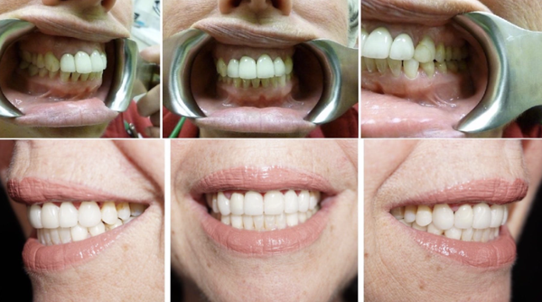 Smile Gallery - To see what our dentists have done to help our patients improve their smiles, we invite you to check out our smile gallery! Dr. Golgoun Habibi and our team strive to give each patient the personalized and thorough care they deserve simply because they want you to be happy with your smile. To learn more about what our team at Aesthetics & Essentials Dental Group can do for you, we welcome you to contact our office today! We look forward to helping you achieve your picture-perfect smile with our comprehensive dentistry in Mountain View, California. Smile Gallery - To see what our dentists have done to help our patients improve their smiles, we invite you to check out our smile gallery! Dr. Golgoun Habibi and our team strive to give each patient the personalized and thorough care they deserve simply because they want you to be happy with your smile. To learn more about what our team at Aesthetics & Essentials Dental Group can do for you, we welcome you to contact our office today! We look forward to helping you achieve your picture-perfect smile with our comprehensive dentistry in Mountain View, California.
