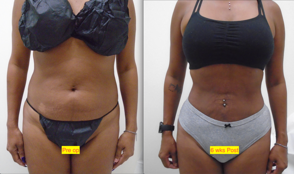 Rejuvenate your shape - Mother of two children presented for Liposuction of the abdomen after "thinking about it " for one year. The second photo was takin approximately six weeks later. She was quite pleased with the loss of four inches from her waistline three months later. Rejuvenate your shape - Mother of two children presented for Liposuction of the abdomen after "thinking about it " for one year. The second photo was takin approximately six weeks later. She was quite pleased with the loss of four inches from her waistline three months later.