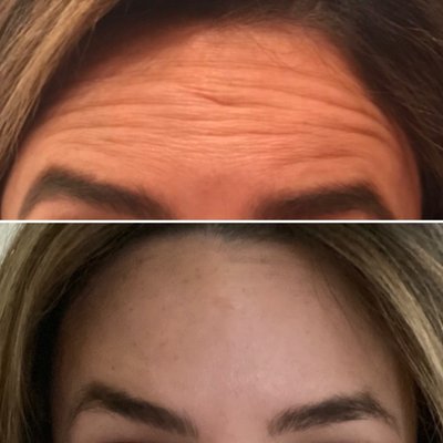 Before and Afters: Injectables - View our talented staff's before and after photos! Before and Afters: Injectables - View our talented staff's before and after photos!