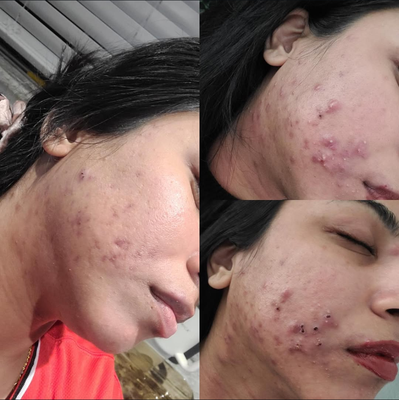 Clear Skin Transformation – Severe Acne Relief - This client came to us struggling with persistent acne flare-ups. Through a customized approach combining professional treatments every 3-4 weeks and a dedicated Eminence Organic Skin Care home regimen, we were able to achieve incredible results.
After just two months of consistent care, her skin has transformed—experiencing fewer breakouts, reduced inflammation, and a healthier overall complexion. Our holistic approach focuses on organic European skincare techniques and gentle, healing treatments that work with the skin, not against it.
Every client’s skin is unique, and we take pride in creating personalized solutions that bring long-term balance and radiance. Book a consultation today and start your journey to clear, healthy skin! Clear Skin Transformation – Severe Acne Relief - This client came to us struggling with persistent acne flare-ups. Through a customized approach combining professional treatments every 3-4 weeks and a dedicated Eminence Organic Skin Care home regimen, we were able to achieve incredible results.
After just two months of consistent care, her skin has transformed—experiencing fewer breakouts, reduced inflammation, and a healthier overall complexion. Our holistic approach focuses on organic European skincare techniques and gentle, healing treatments that work with the skin, not against it.
Every client’s skin is unique, and we take pride in creating personalized solutions that bring long-term balance and radiance. Book a consultation today and start your journey to clear, healthy skin!